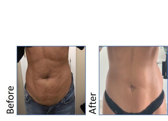 West Hills Cavi-Lipo before and after - only 3 sessions :)