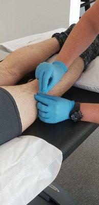 Dry needling intramuscular therapy