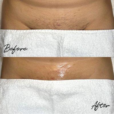 Before + After Brazilian Sugaring