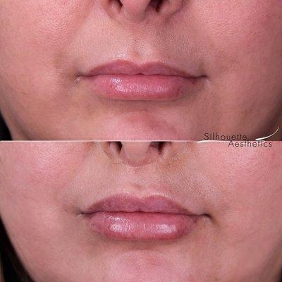 Surgical lip lift