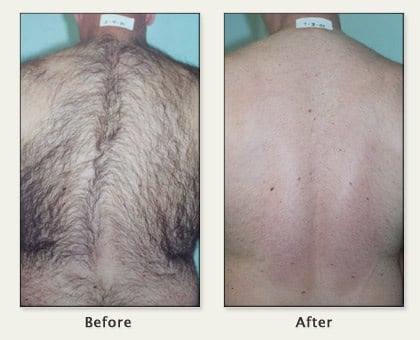 Back hair before and after laser hair removal