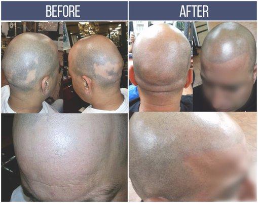 Scalp Micro-pigmentation Alopecia Areata