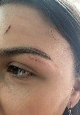 14 year old daughter was burned during her first eye brow wax. Very upset and hope it won't scar