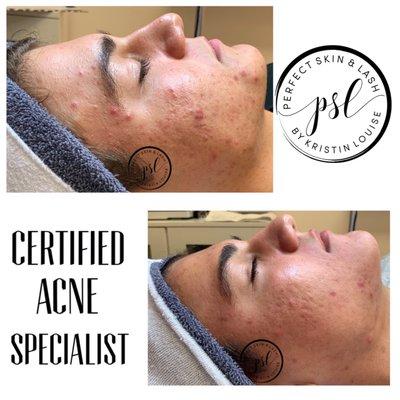 Certified Acne Specialist - client is in the process of getting clear.