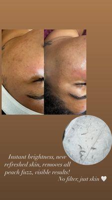 Instant results from a Dermaplane facial