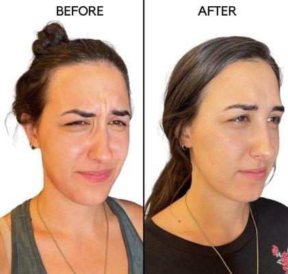 Before and after treatment with Jeuveau neurotoxin