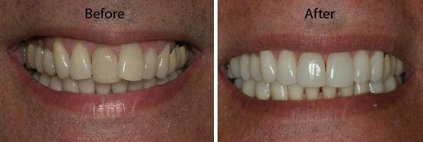 Invisalign Coral Springs, FL