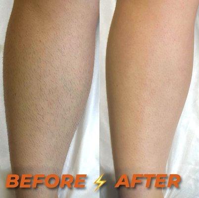 Half legs sugaring. Before/after- the result is obvious