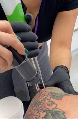 Laser Tattoo Removal