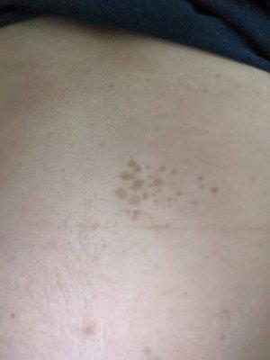 scars left from cupping