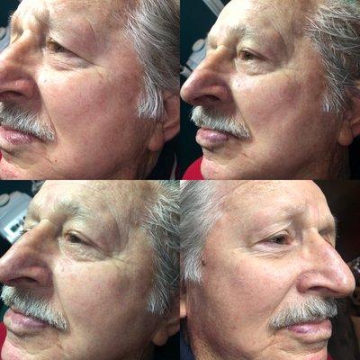 Men's facial with a nose and ear wax