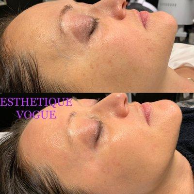 Intraceuticals Celebrity Oxygen & Rezenerate Combo ( One Treatment, results after 1 hour)