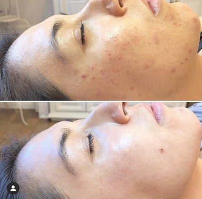 4 months on our face reality acne program!