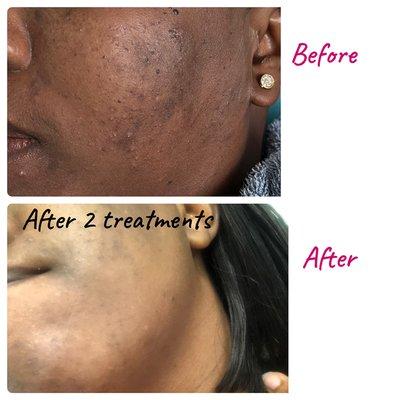 Chemical Peel for Acne & Hyperpigmentation