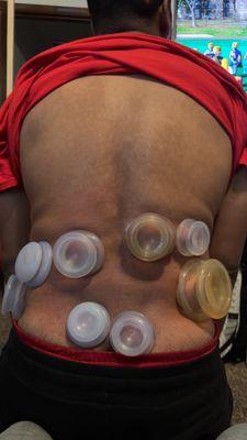 Cupping Therapy (silicone cups)