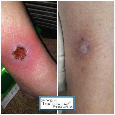 Before & after treatment venous ulcer