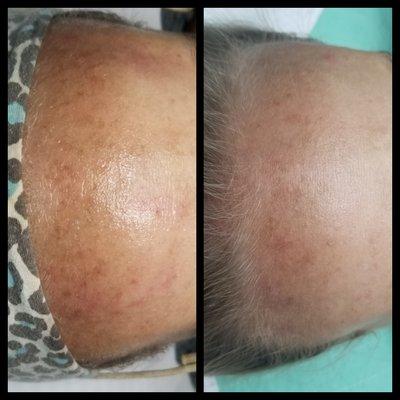 Hyperpigmentation before and after photo after one IPL treatment.