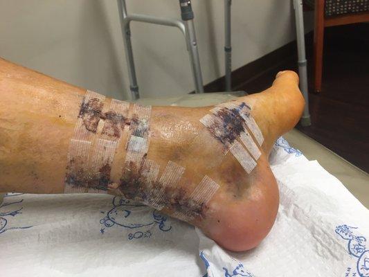 My foot after a tendon lengthening surgery! Looking like a Frankenstein foot hahaha