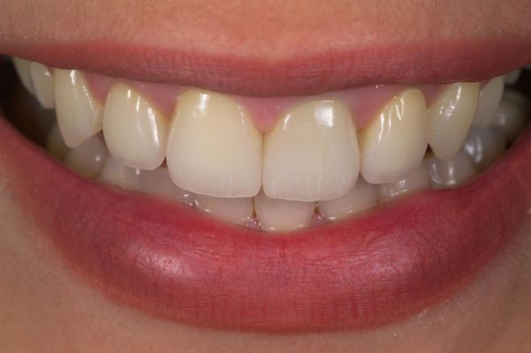 Cosmetic Dental work performed by Dr Steven Ghim DMD