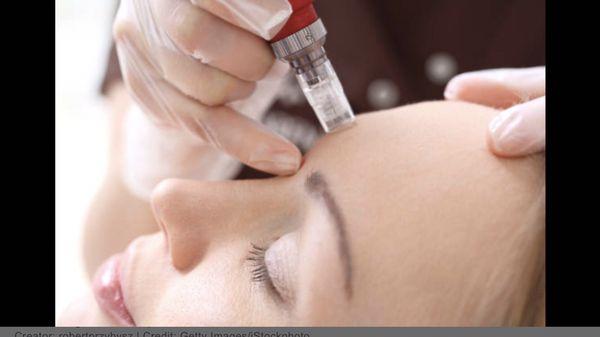 Micro needling