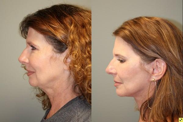 Before and after Facelift