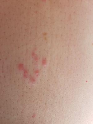 Bed bug bites