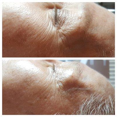 Before and After Eye Peptide