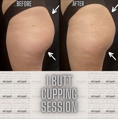 Butt cupping