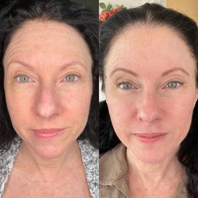 Before and after plasma skin tightening full face 8 days after treatment.