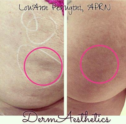 Cellulite treatments