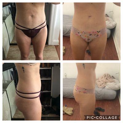 Before and after photos from 3 treatments done on my stomach and thighs/butt