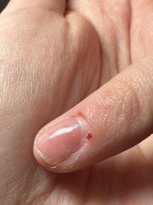 Cuts and burns from nail technician