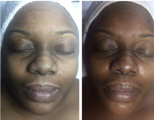 Before and After Chemical Peel Tone Corrector