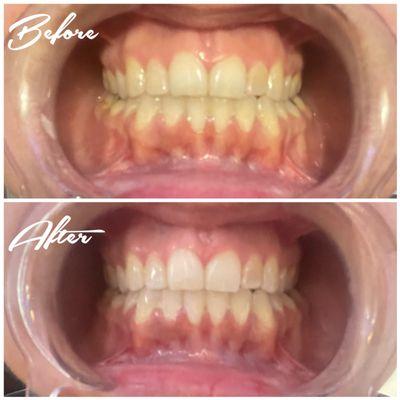 1x Teeth Whitening Treatment