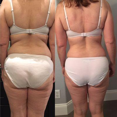 Love handles, cellulite reduction, and tighter skin! After 12 treatments