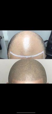 Scalp Micropigmentation