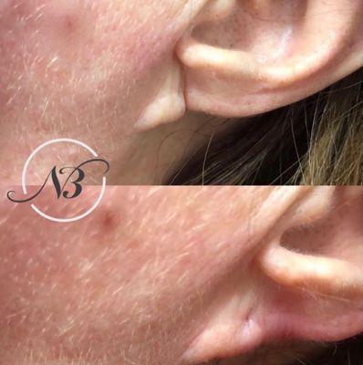 Earlobe restoration