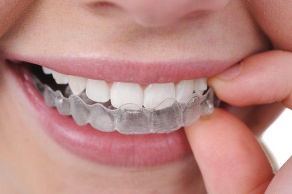 The Ease Of Invisalign