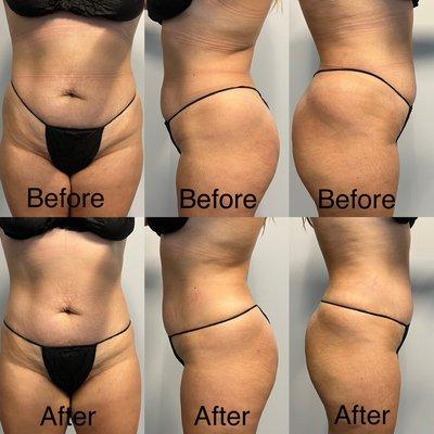 This is the results after just one session of our body contouring.