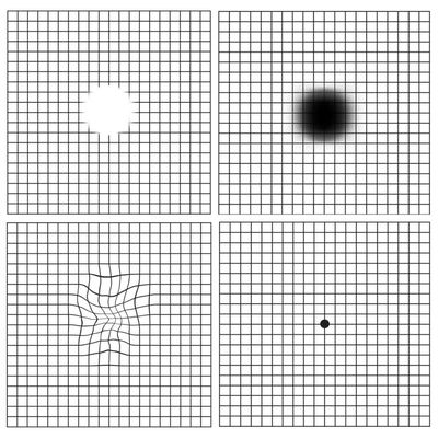 An Amsler grid is a sensitive tool for finding macular problems. Any waviness, distortion, missing or dark spots are concerning.