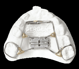 RPE with Tongue Crib fabricated in the USA by David Gergen from Gergen's Orthodontic Lab