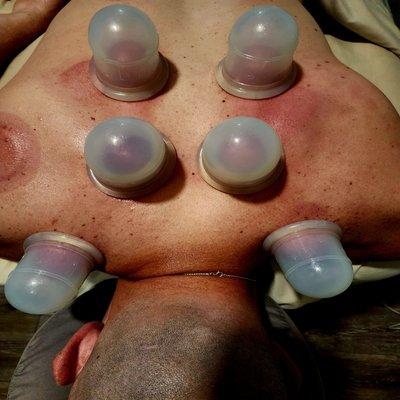 Cupping Therapy