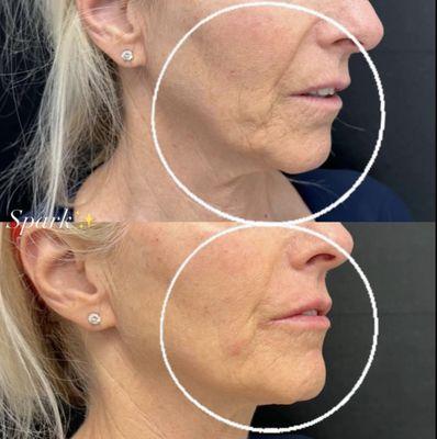 Non-surgical Lower Face Rejuvenation. Before & Immediately After Injections