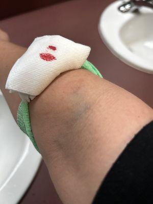 The worst and most painful blood draw I've had