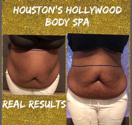 Before and after non-invasive liposuction