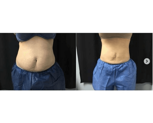 CoolSculpting