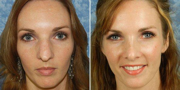 Rhinoplasty