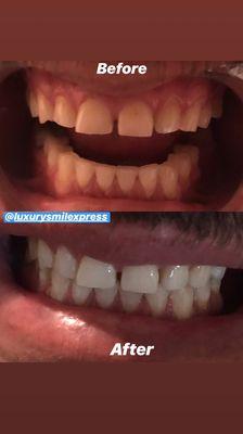 Before and after done by Luxury Smile Xpress.