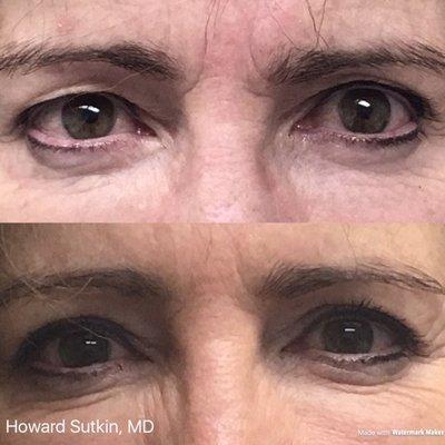 Upper Eyelid Procedure (Blepharoplasty) - 3 Weeks Post-op