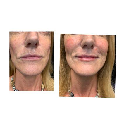 Liquid Face Lift